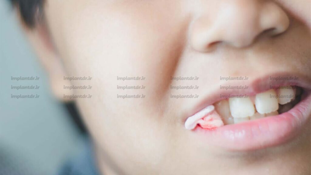 گذاشتن گاز استریل رو ی محل خونریزی