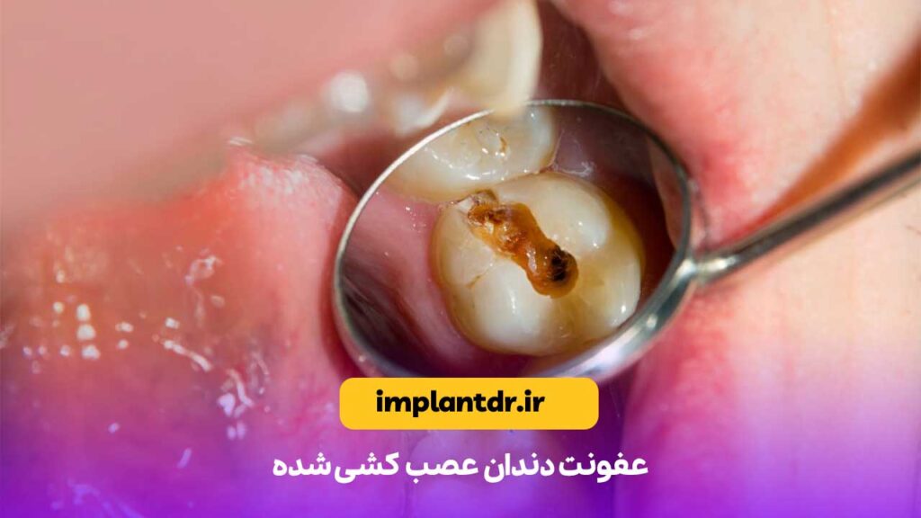 عفونت دندان عصب کشی شده