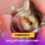 عفونت دندان عصب کشی شده
