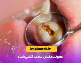 عفونت دندان عصب کشی شده
