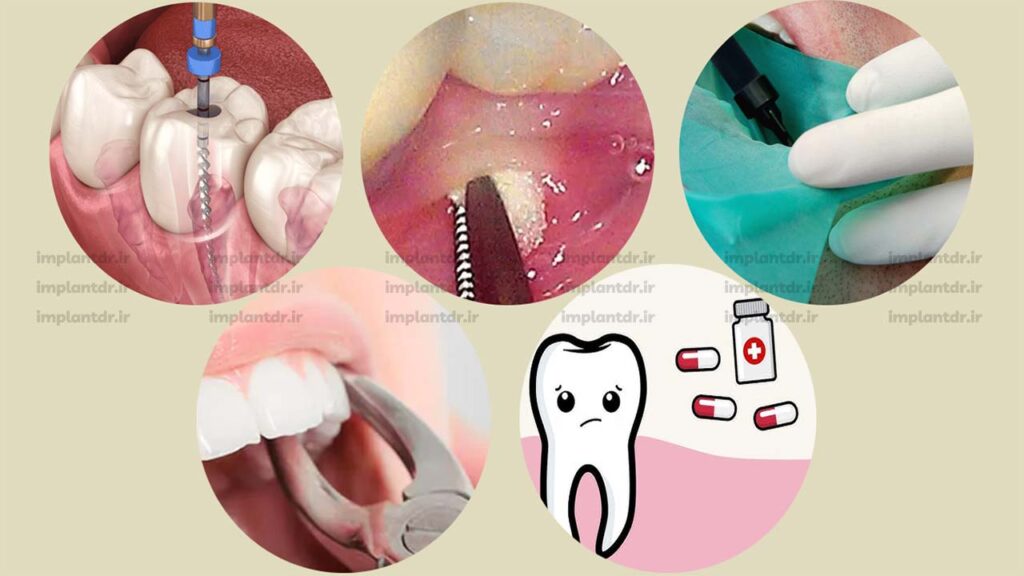 روش های درمان عفونت دندان عصب کشی شده
