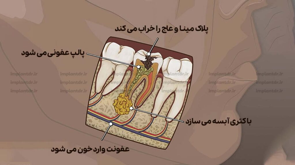 عفونت دندان عصب کشی شده چیست؟