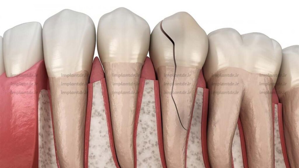ترک خوردن دندان