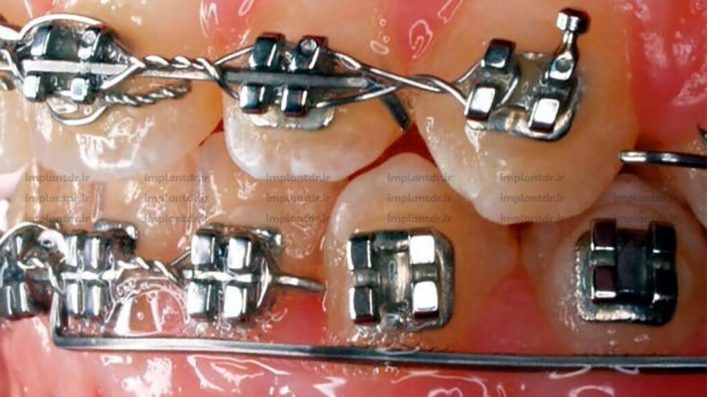 براکت شکسته