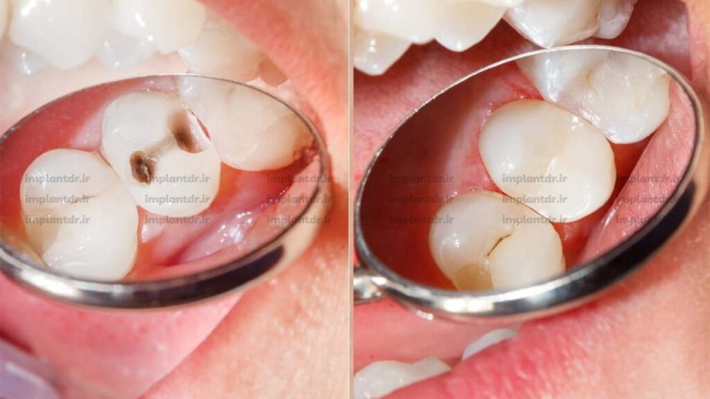 پر کردن دندان ‌های پوسیده