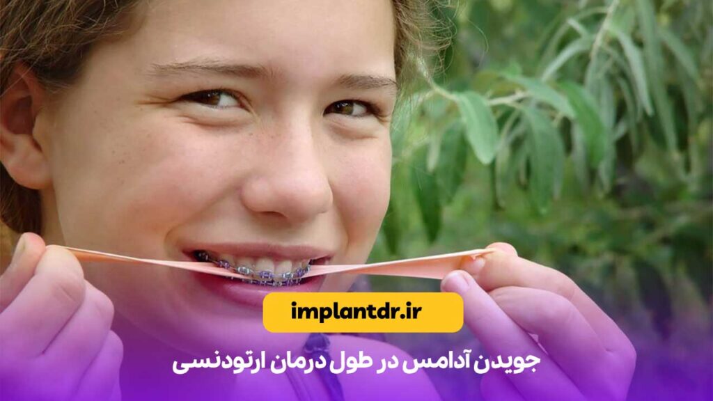 جویدن آدامس در طول درمان ارتودنسی