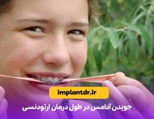 جویدن آدامس در طول درمان ارتودنسی