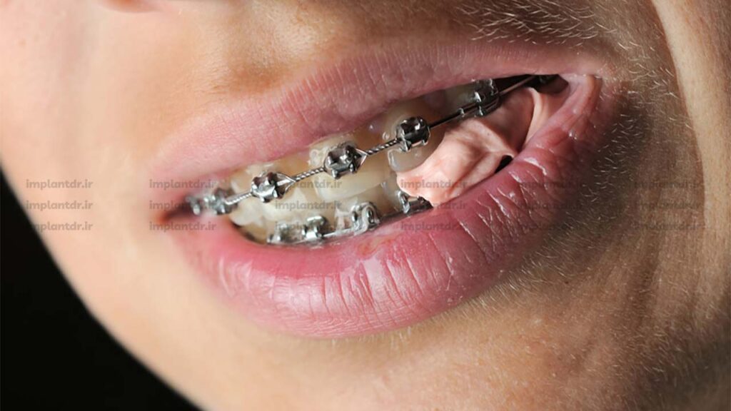 چسبندگی آدامس به براکت ها