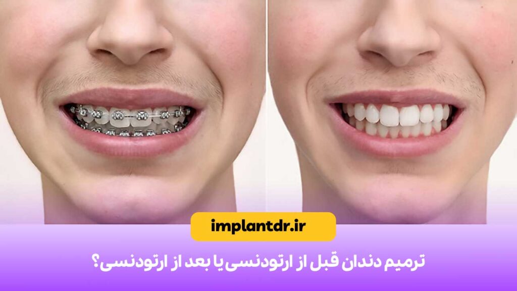 ترمیم دندان قبل از ارتودنسی یا بعد از ارتودنسی