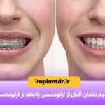ترمیم دندان قبل از ارتودنسی یا بعد از ارتودنسی