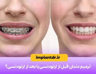 ترمیم دندان قبل از ارتودنسی یا بعد از ارتودنسی