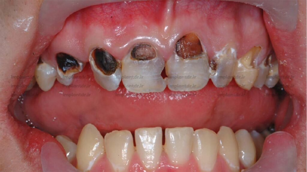 پوسیدگی فعال دندان