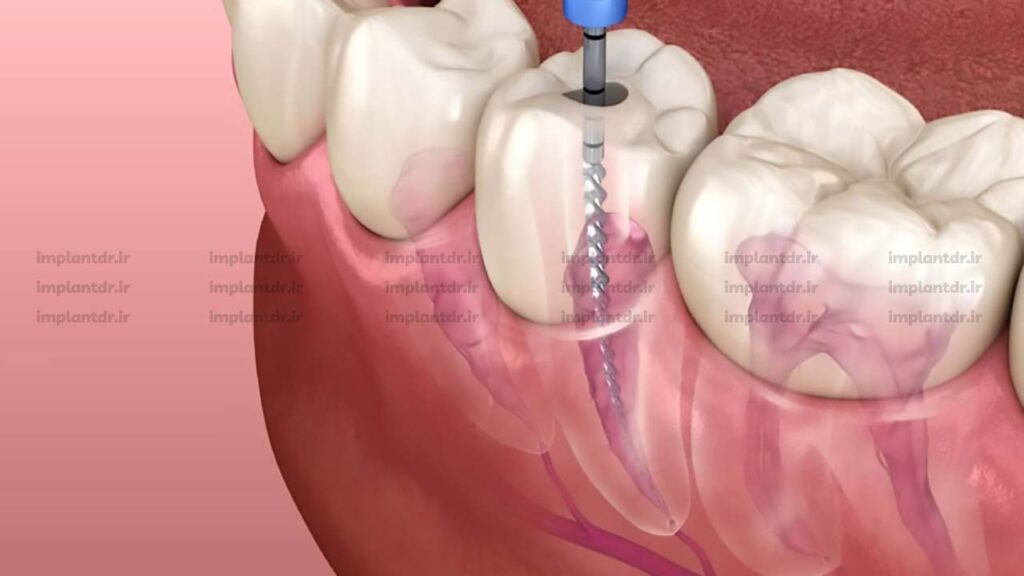 درمان ریشه دندان