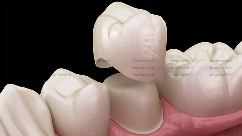 ترمیم های زیبایی دندان